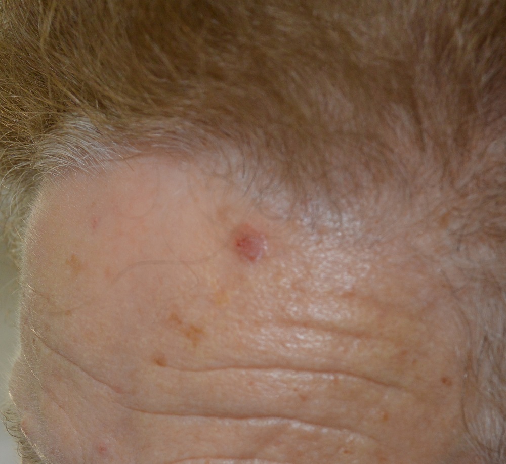 Imagen Dermatoscopica