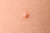 LO QUE DEBES SABER SOBRE EL MOLUSCO CONTAGIOSO