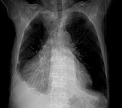 Caso Cl&iacute;nico N&ordm;2. Derrame Perioc&aacute;rdico, Derrame Pleural y dilataci&oacute;n de cavidades derechas, aproximaci&oacute;n ecogr&aacute;fica desde la consulta de Atenci&oacute;n Primaria - Ginecolog&iacute;a y Obst&eacute;trica