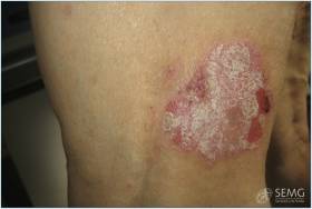 Aunque la psoriasis mejora en verano con el sol &ldquo;no hay que olvidar que tambi&eacute;n existe riesgo&rdquo;