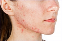 Aumenta la prevalencia del acné en mujeres adultas, que alcanza el 45% en mayores de 20 años